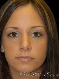 Rhinoplasty after at Chau Plastic Surgery in Berkley, MI