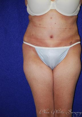 Chau Plastic Surgery tummy tuck after — Berkley, MI