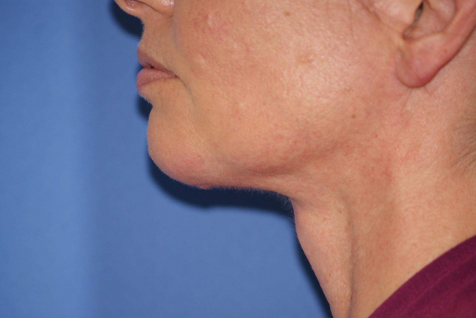 Chau Plastic Surgery neck lift after — Berkley, MI