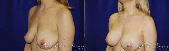 Breast Augmentation result at Chau Plastic Surgery in Berkley, MI