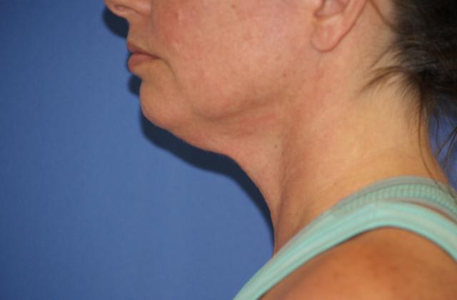 Neck Lift before at Chau Plastic Surgery in Berkley, MI