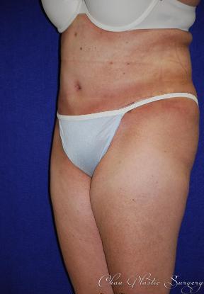 Chau Plastic Surgery tummy tuck after — Berkley, MI