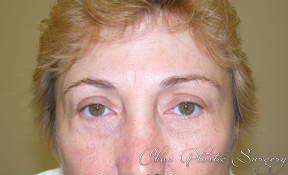 Blepharoplasty after at Chau Plastic Surgery in Berkley, MI