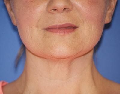 Neck Lift before at Chau Plastic Surgery in Berkley, MI