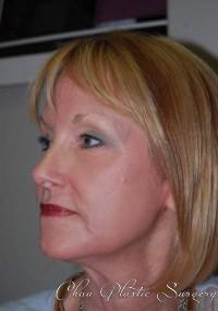Chau Plastic Surgery laser treatment after — Berkley, MI