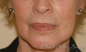 Chau Plastic Surgery laser treatment after — Berkley, MI