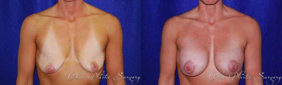 Breast Augmentation result at Chau Plastic Surgery in Berkley, MI