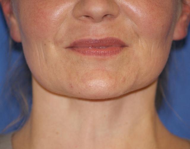 Neck Lift after at Chau Plastic Surgery in Berkley, MI