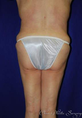 Chau Plastic Surgery tummy tuck after — Berkley, MI