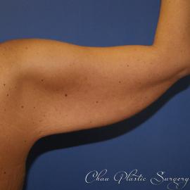 Arm Lift before at Chau Plastic Surgery in Berkley, MI