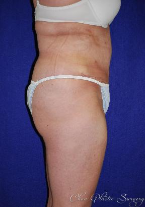 Chau Plastic Surgery tummy tuck after — Berkley, MI