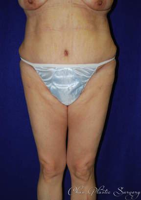 Chau Plastic Surgery tummy tuck after — Berkley, MI