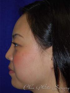 Chau Plastic Surgery rhinoplasty after — Berkley, MI