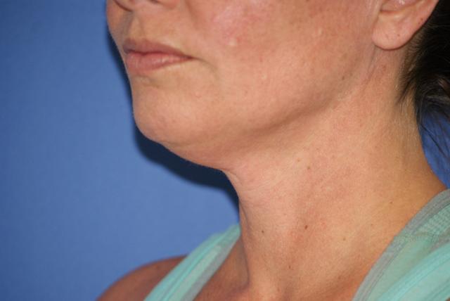 Neck Lift before at Chau Plastic Surgery in Berkley, MI