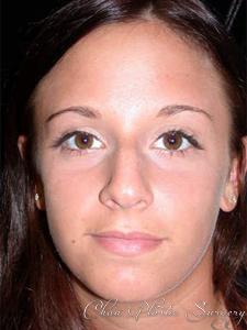 Rhinoplasty before at Chau Plastic Surgery in Berkley, MI