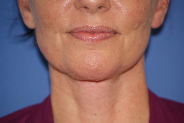 Neck Lift after at Chau Plastic Surgery in Berkley, MI