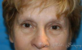 Blepharoplasty before at Chau Plastic Surgery in Berkley, MI