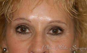 Blepharoplasty after at Chau Plastic Surgery in Berkley, MI