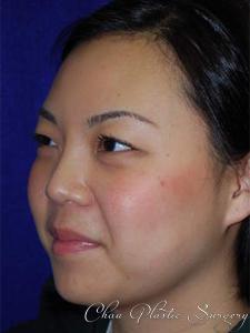 Chau Plastic Surgery rhinoplasty after — Berkley, MI
