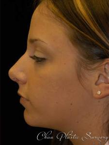 Rhinoplasty after at Chau Plastic Surgery in Berkley, MI