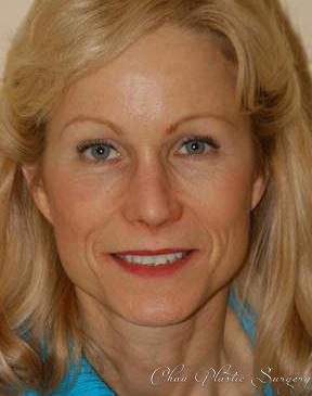 Brow Lift after at Chau Plastic Surgery in Berkley, MI