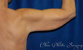 Arm Lift before at Chau Plastic Surgery in Berkley, MI