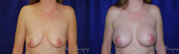 Breast Augmentation result at Chau Plastic Surgery in Berkley, MI