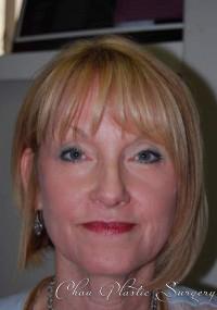 Chau Plastic Surgery laser treatment after — Berkley, MI