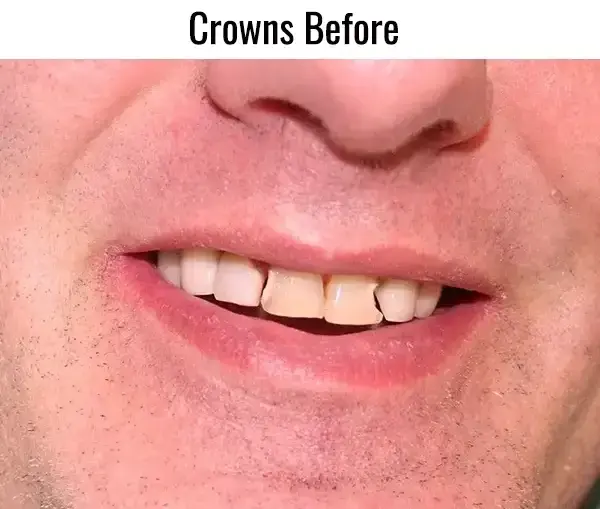 Dental Crowns before at Sachs Family Dental in Orem, UT
