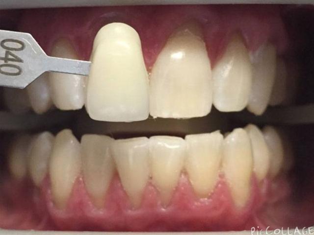 Teeth Whitening after at Sachs Family Dental in Orem, UT