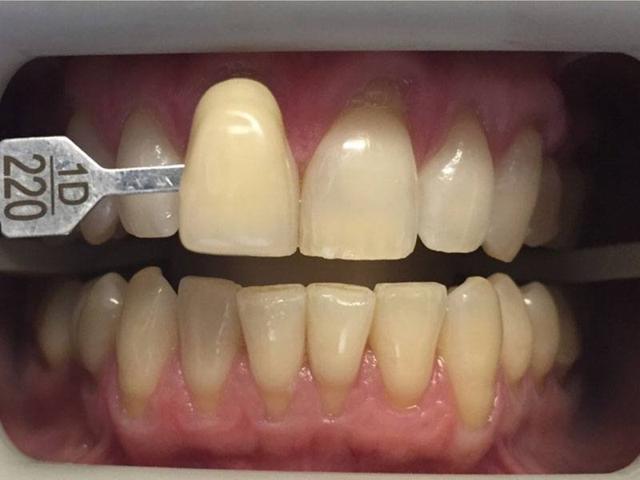 Teeth Whitening before at Sachs Family Dental in Orem, UT