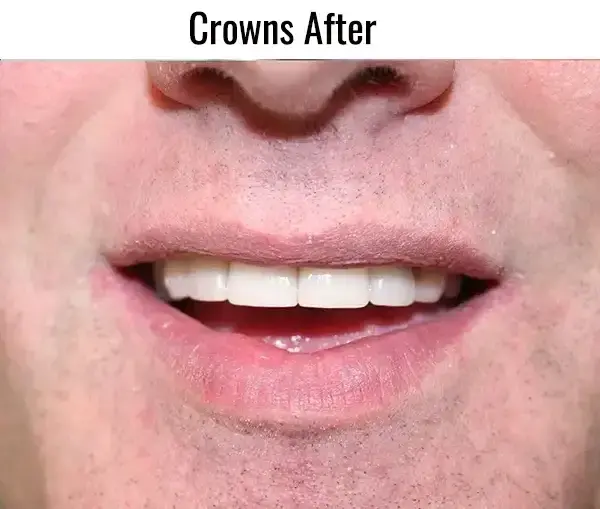 Dental Crowns after at Sachs Family Dental in Orem, UT