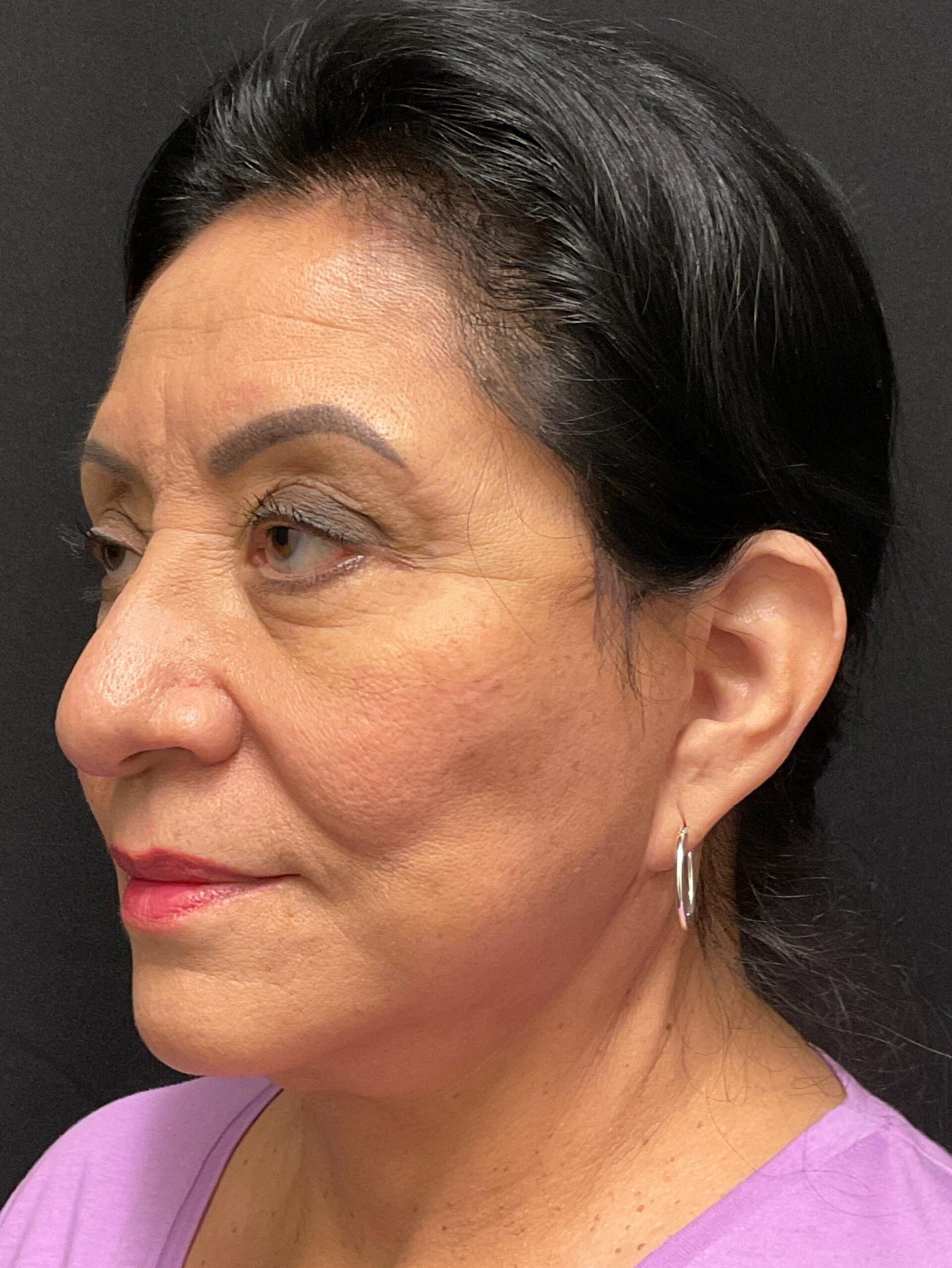 Snyder Plastic Surgery facelift after — Austin, TX