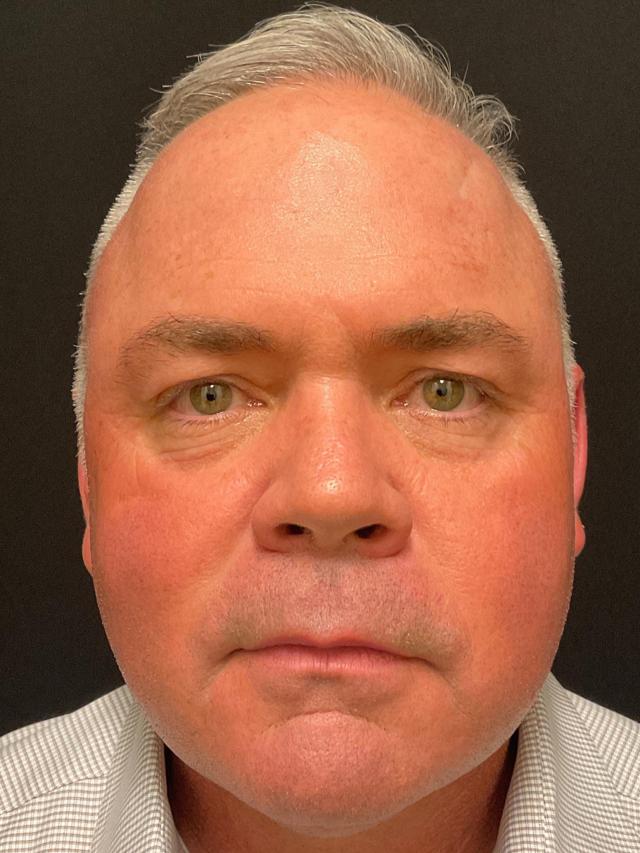 Blepharoplasty before at Snyder Plastic Surgery in Austin, TX