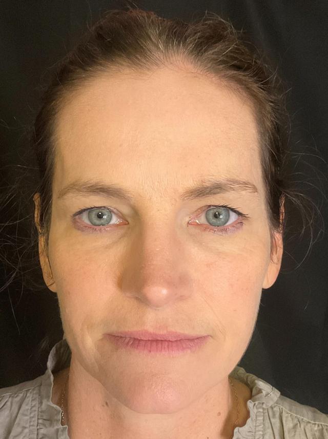 Blepharoplasty before at Snyder Plastic Surgery in Austin, TX