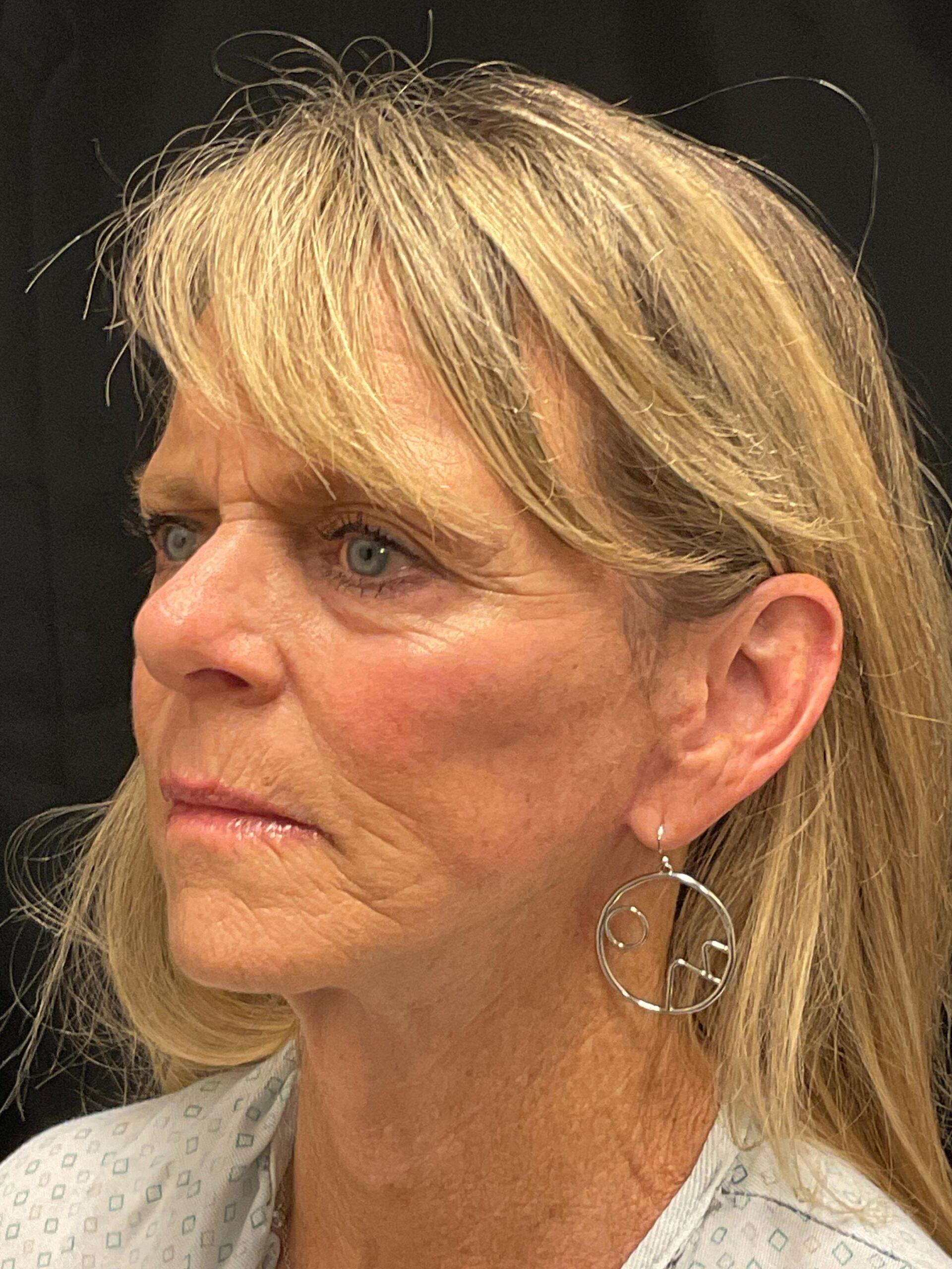 Snyder Plastic Surgery facelift after — Austin, TX