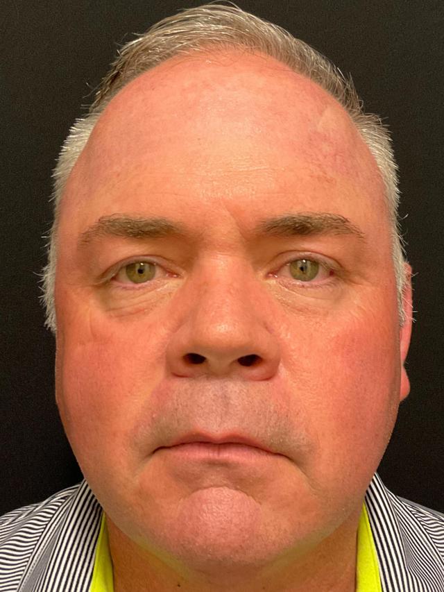 Blepharoplasty after at Snyder Plastic Surgery in Austin, TX