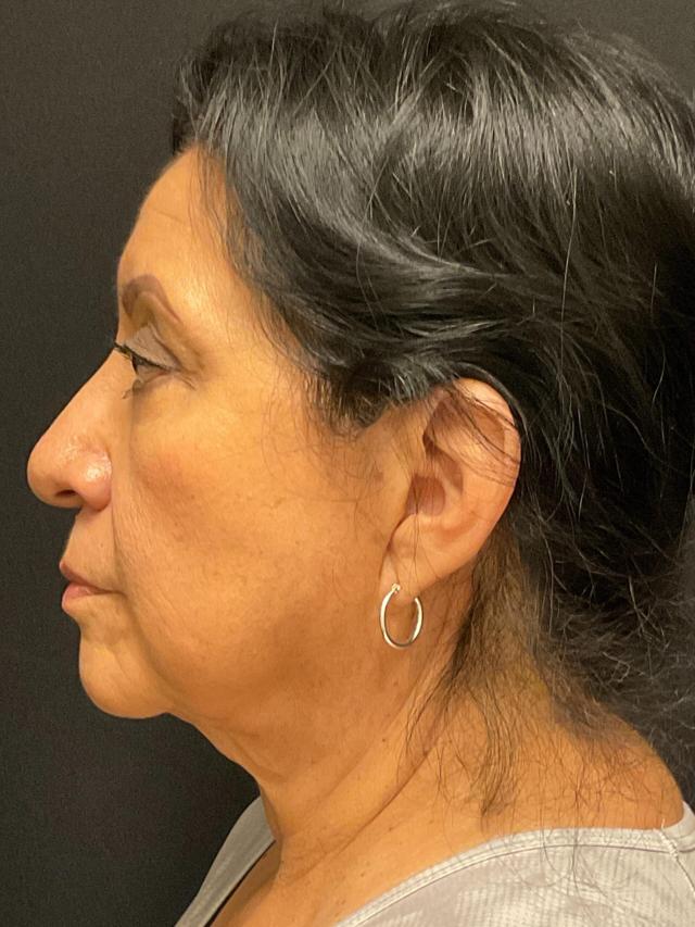Facelift before at Snyder Plastic Surgery in Austin, TX