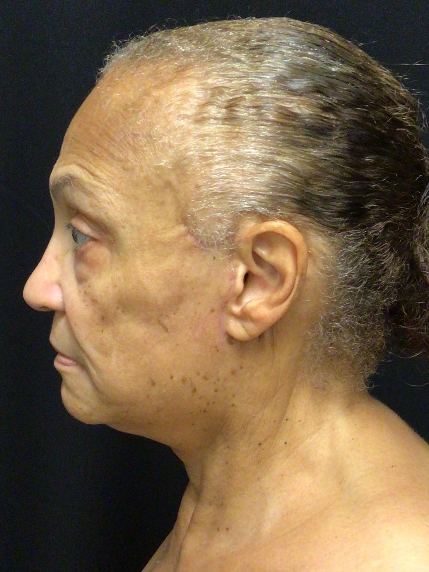 Snyder Plastic Surgery facelift after — Austin, TX