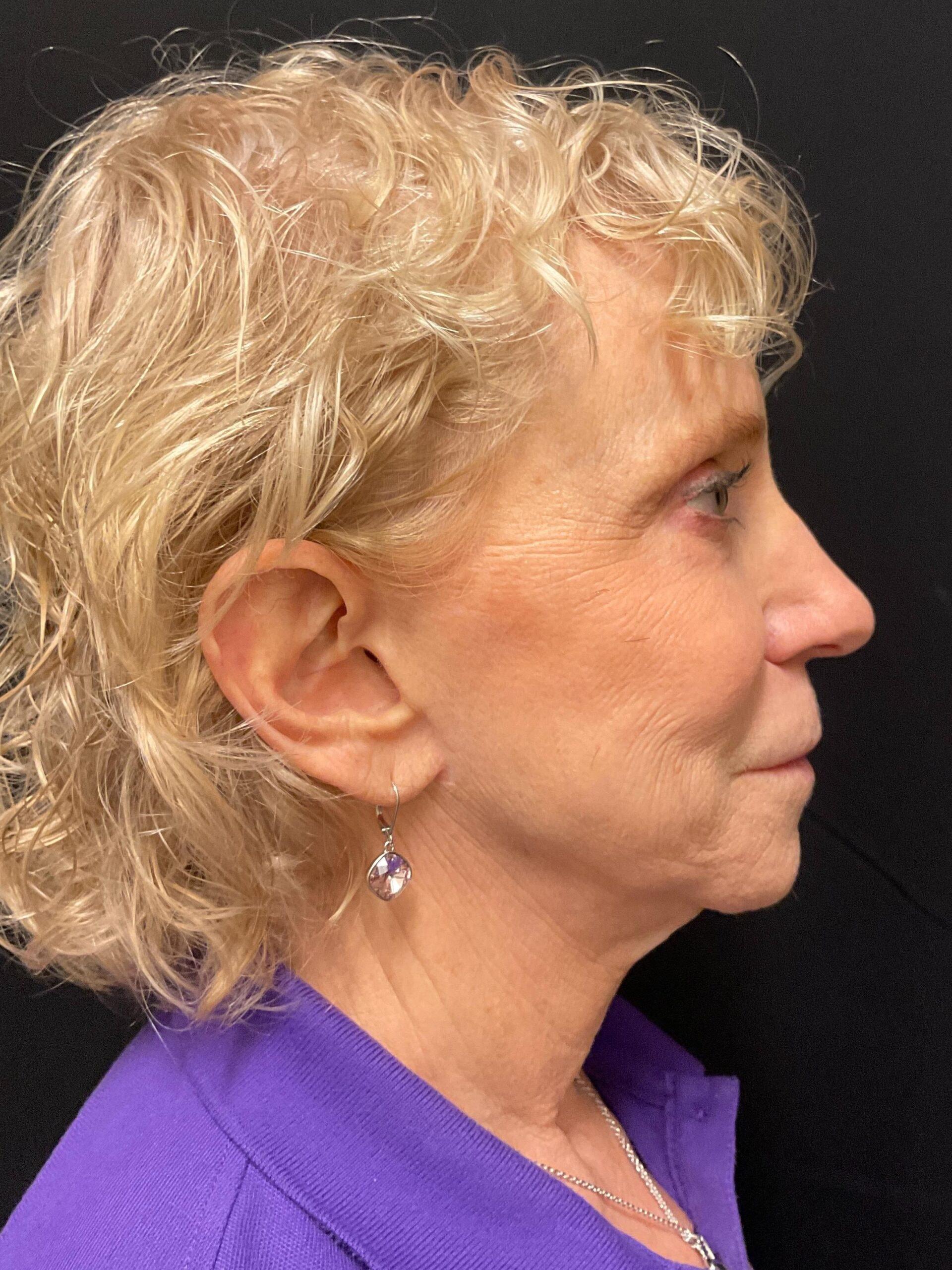 Snyder Plastic Surgery facelift after — Austin, TX