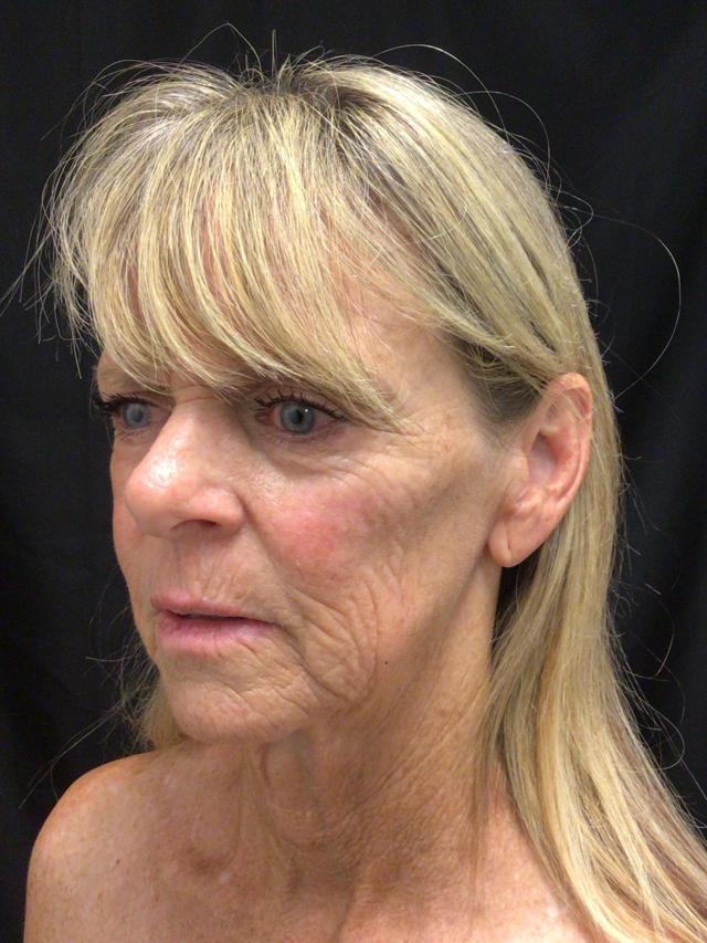 Facelift before at Snyder Plastic Surgery in Austin, TX