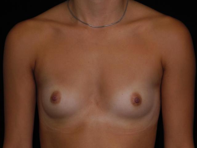 Fat Transfer Breast Augmentation before at Snyder Plastic Surgery in Austin, TX