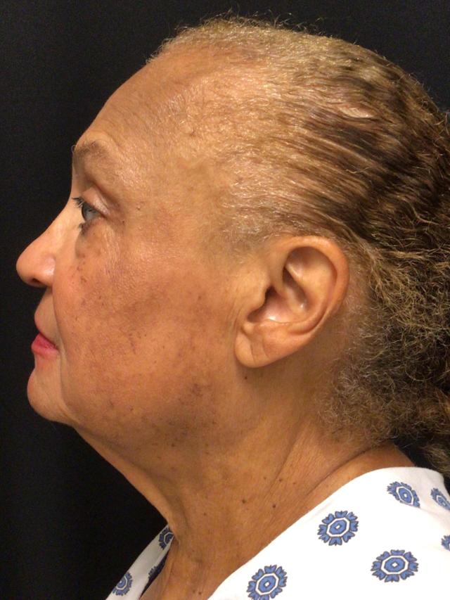 Facelift before at Snyder Plastic Surgery in Austin, TX