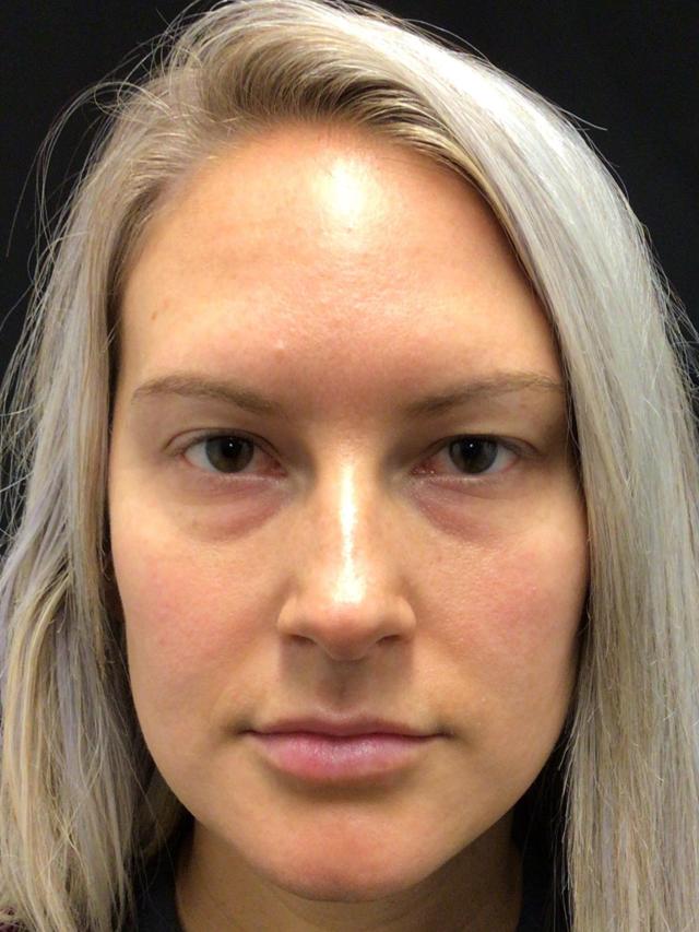 Blepharoplasty after at Snyder Plastic Surgery in Austin, TX