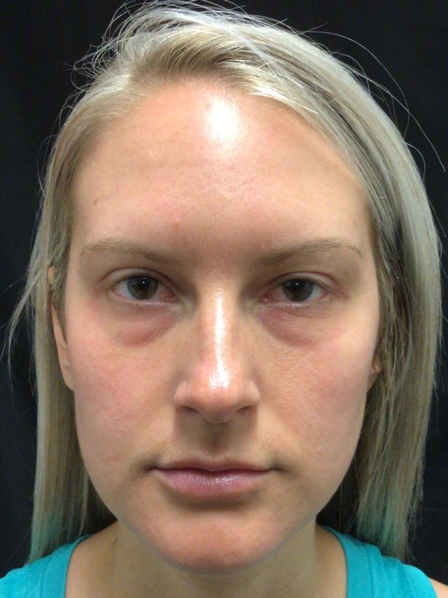 Blepharoplasty before at Snyder Plastic Surgery in Austin, TX