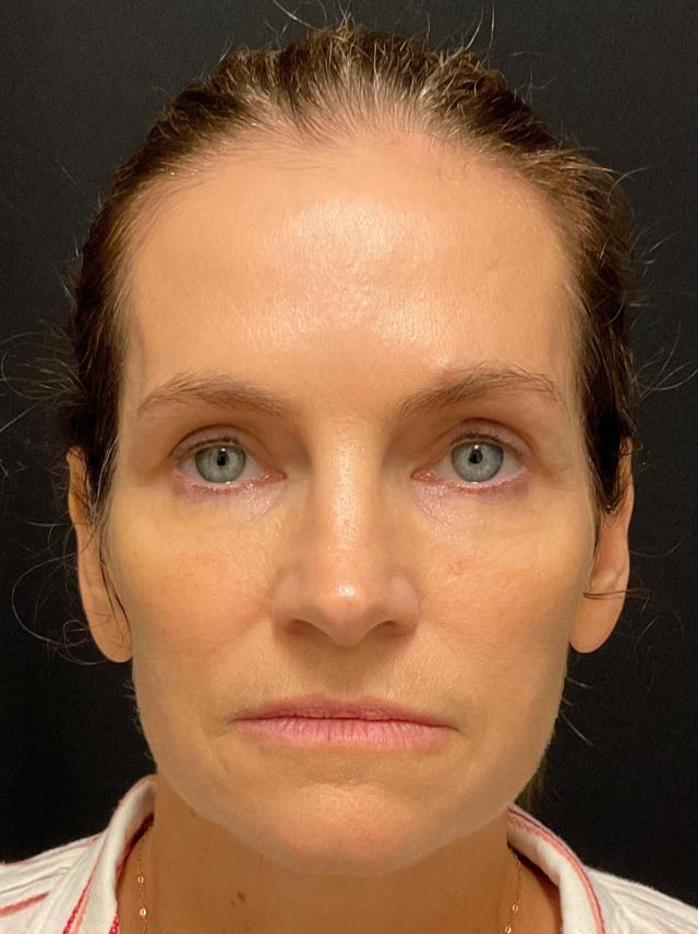 Blepharoplasty after at Snyder Plastic Surgery in Austin, TX