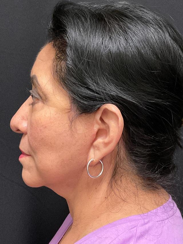 Facelift after at Snyder Plastic Surgery in Austin, TX