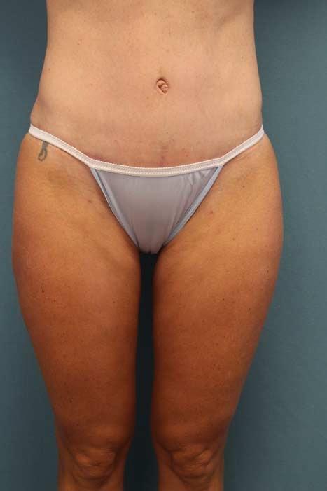 Handal Plastic Surgery tummy tuck after — Boca Raton, FL