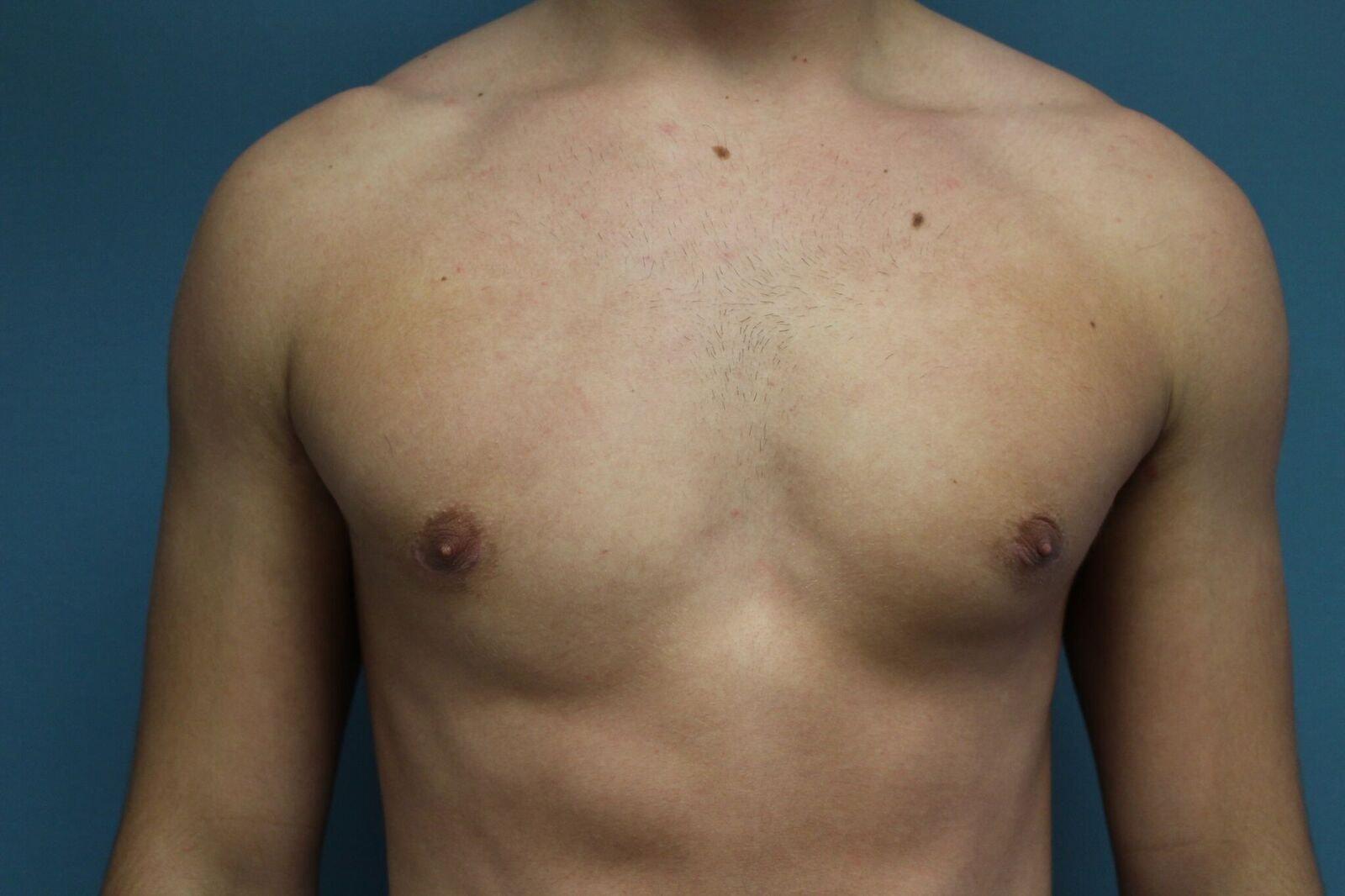 Handal Plastic Surgery gynecomastia after — Boca Raton, FL