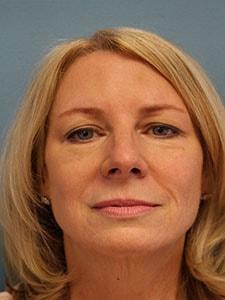 Handal Plastic Surgery eyelid lift after — Boca Raton, FL